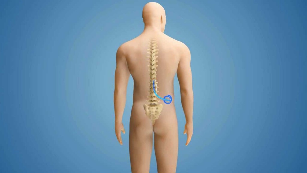 Intratherapy - pumps and multiple sclerosis