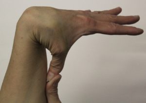 Hypermobility – What are the signs and symptoms of joint hypermobility ...