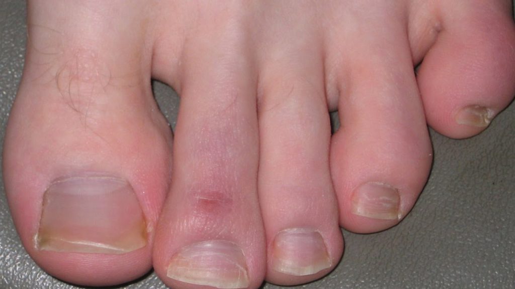 Chilblains 