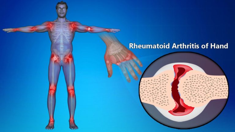 Rheumatoid Arthritis | Patient Talk