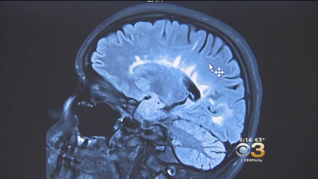 New Drug Could Help Multiple Sclerosis Patients Better Manage Symptoms