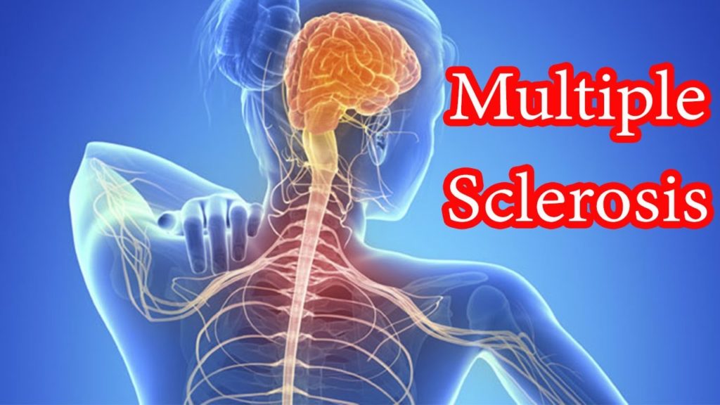 The triggers for Multiple Sclerosis