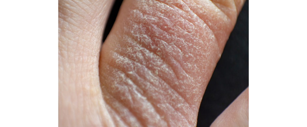 Finger eczema