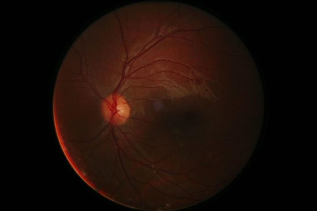 Researchers unravel why episodes of low blood sugar worsen eye disease in people with diabetes